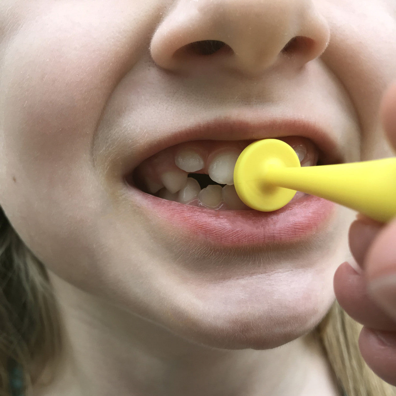 Ark's ProButton Set for Lip Closure/Strength